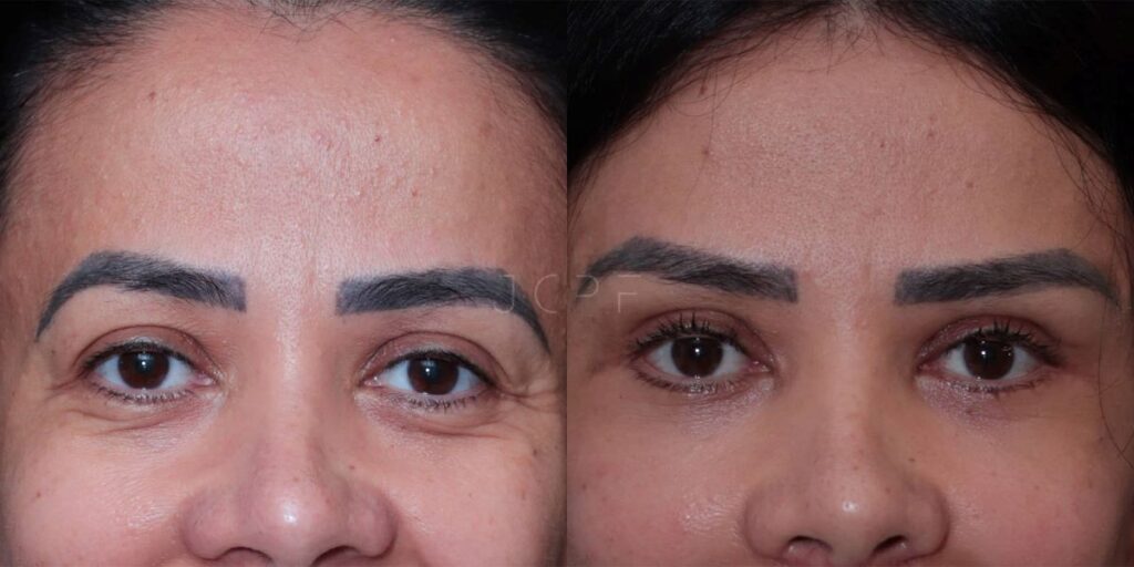 pálpebra caída antes e depois fotos