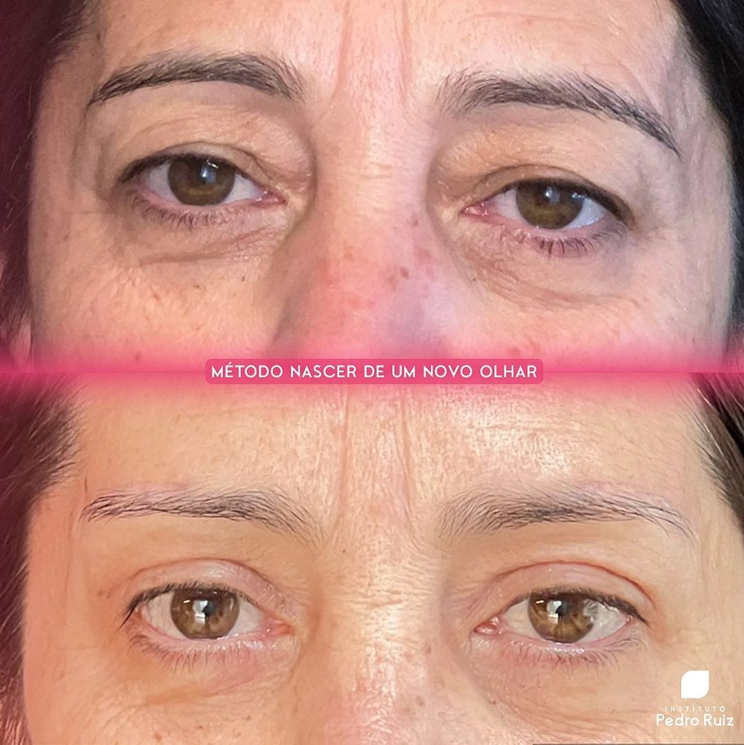 blefaroplastia antes e depois