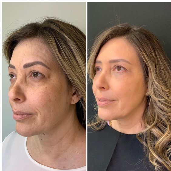tratamento pálpebra caída antes e depois