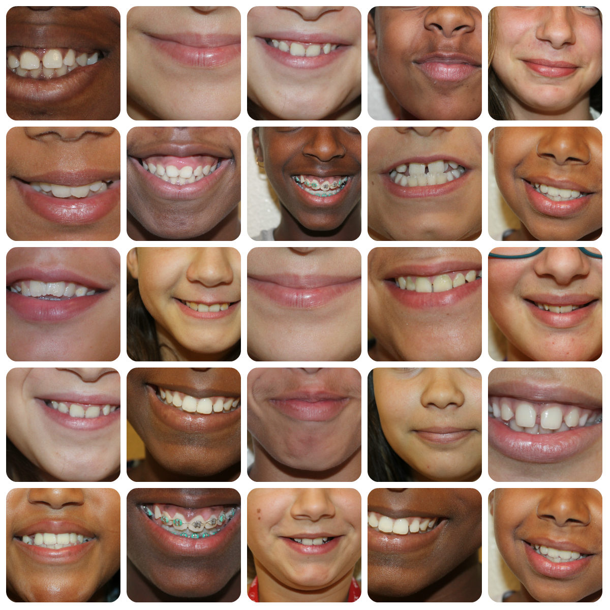 sorriso gengival o que é