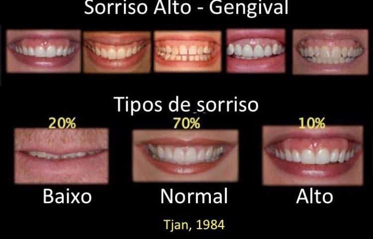 tipos de sorriso e seus significados