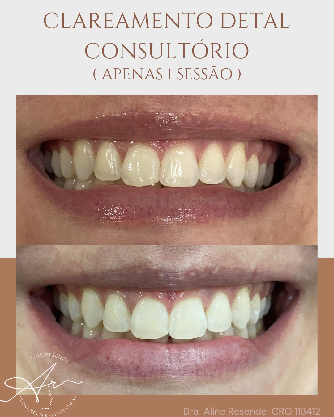 resultados clareamento dental