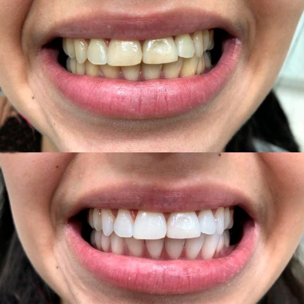 clareamento dental antes e depois fotos