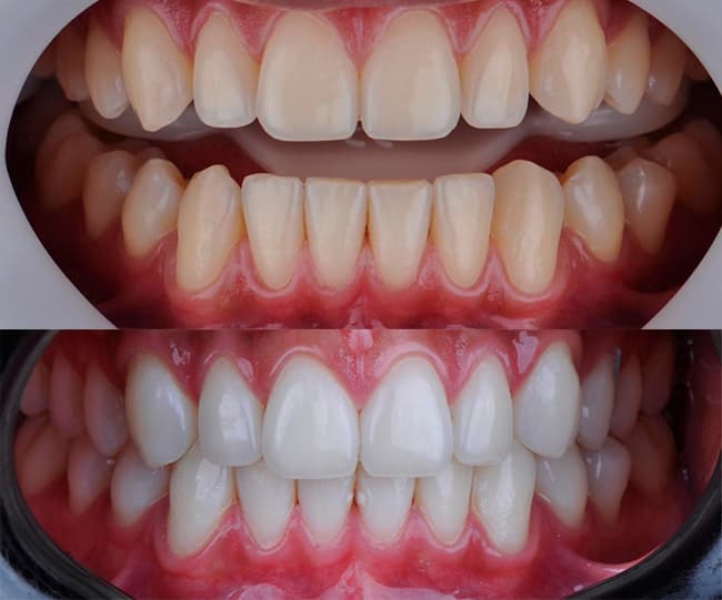resultados clareamento dental