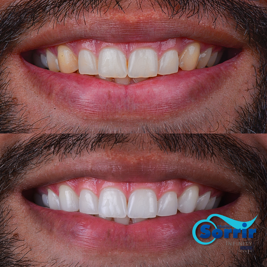 clareamento dental caseiro funciona