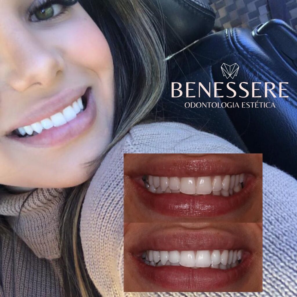 clareamento dental a laser vale a pena