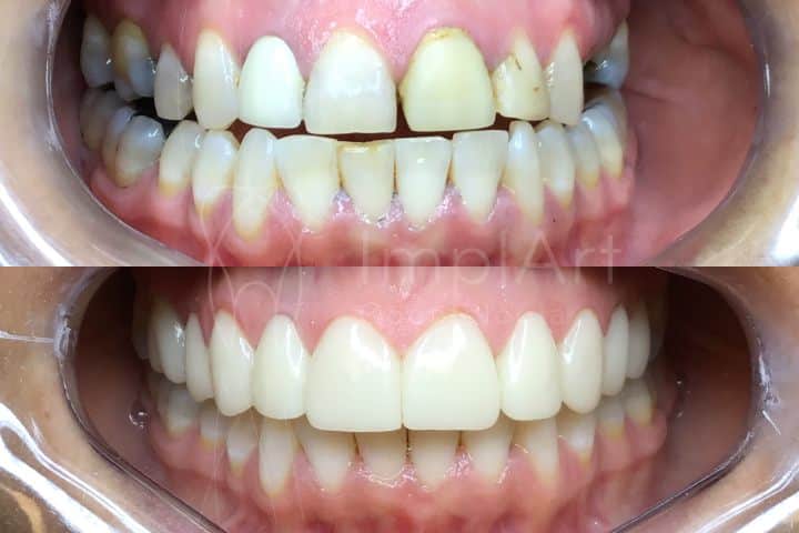 cuidados pós clareamento dental