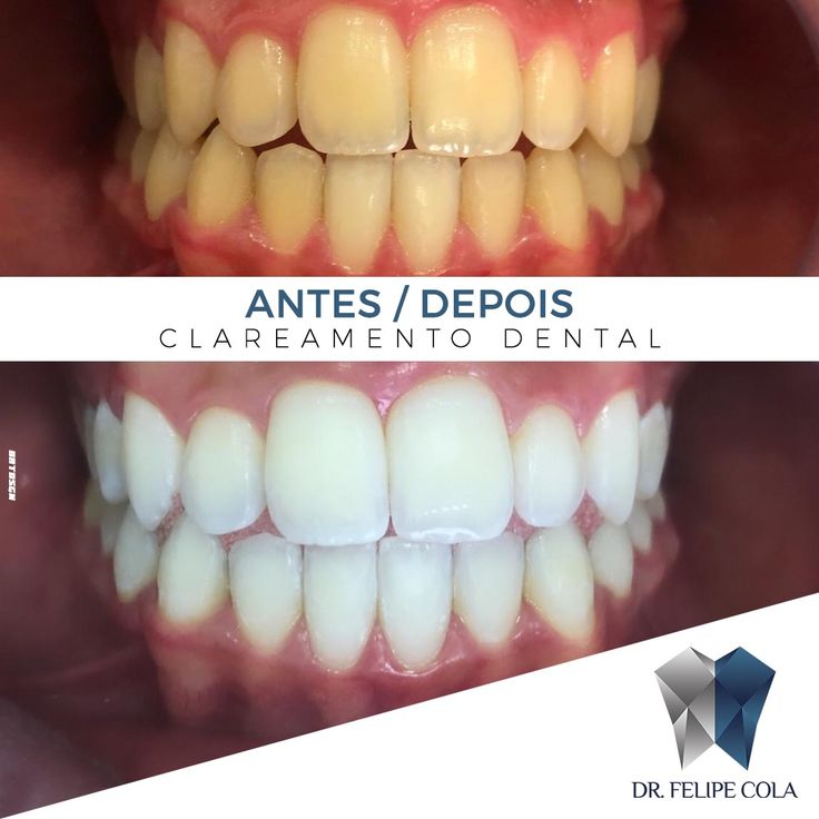 sensibilidade dentes clareamento