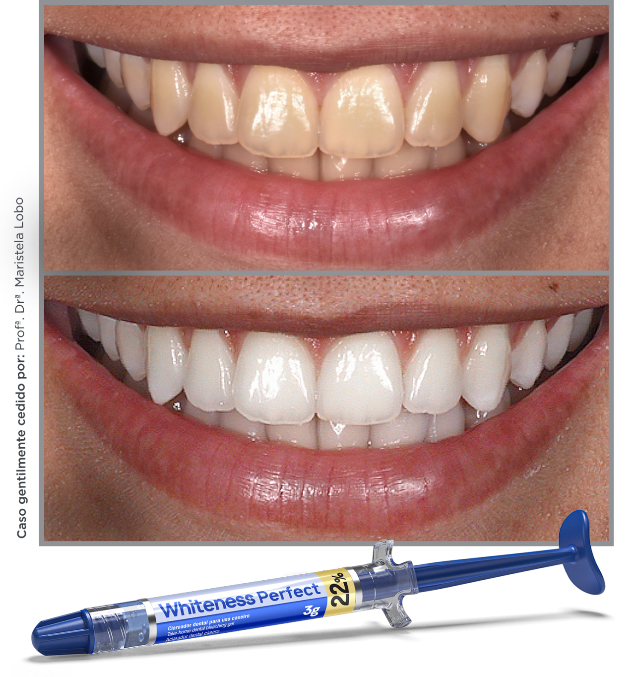 quanto tempo dura clareamento dental