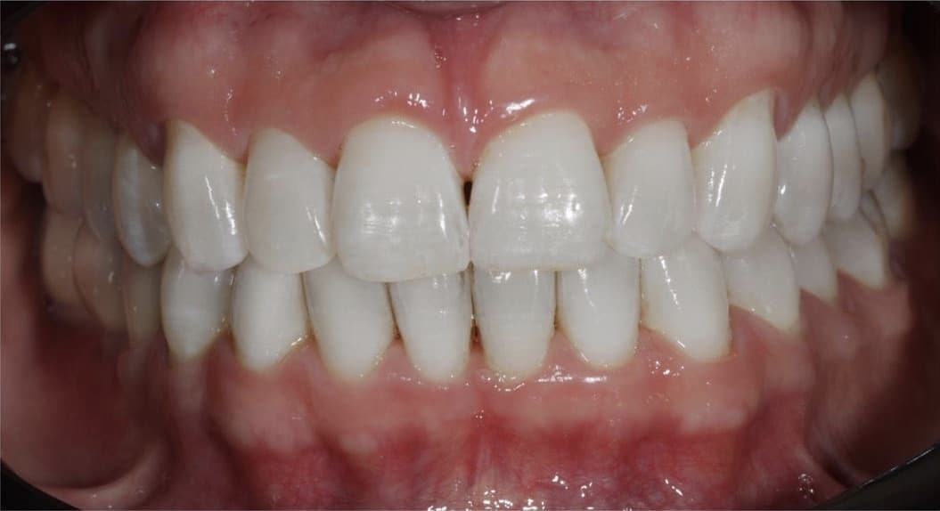 clareamento dental preço