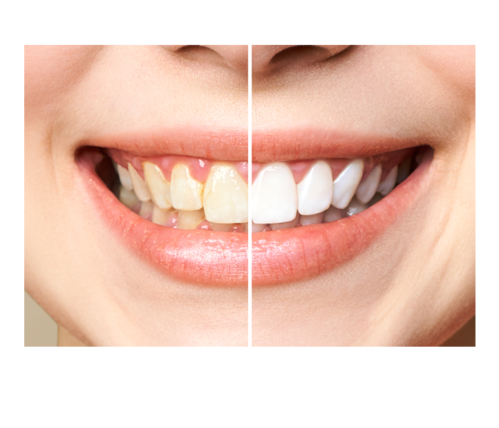 melhor clareamento dental