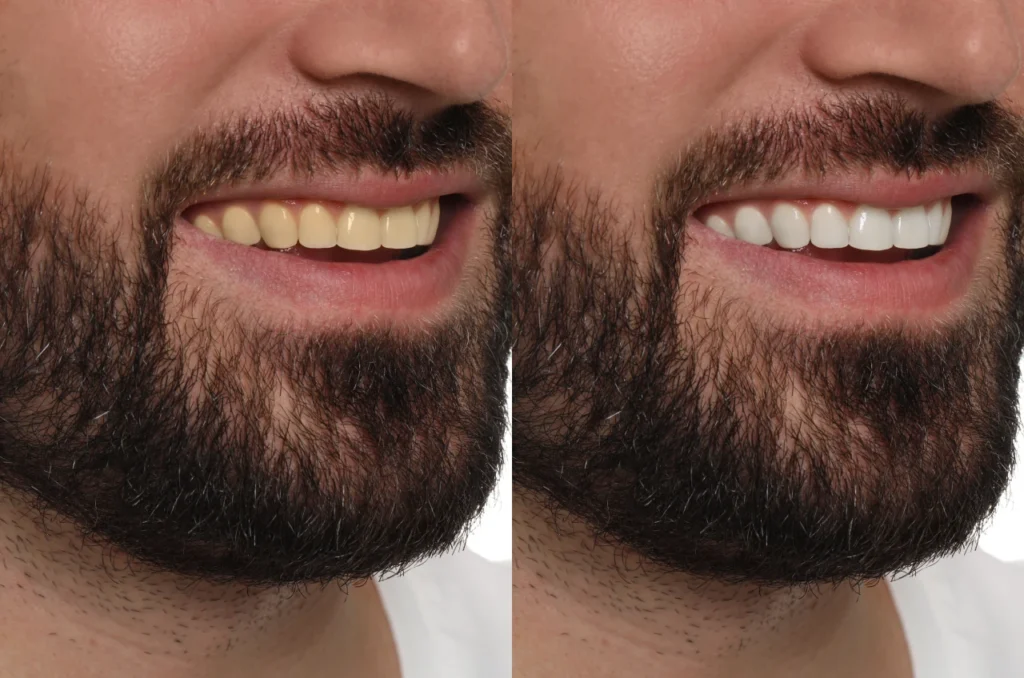 dentes amarelados o que fazer