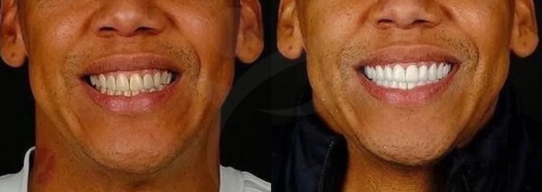 clareamento dental antes e depois fotos