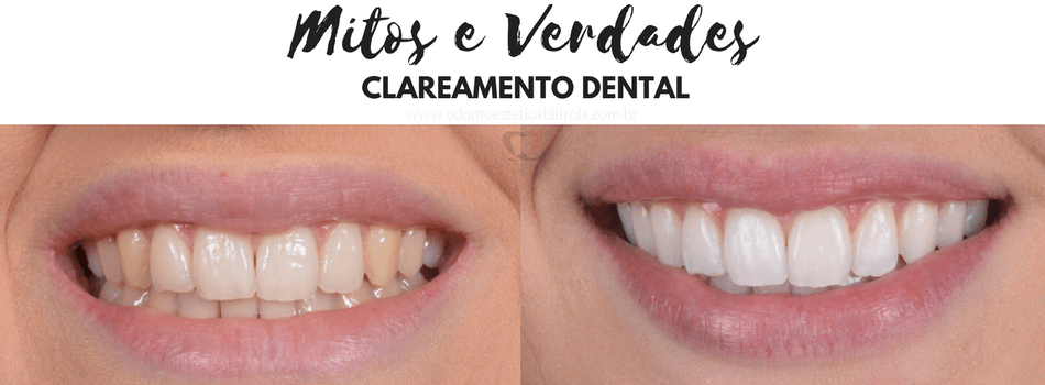 cuidados pós clareamento dental