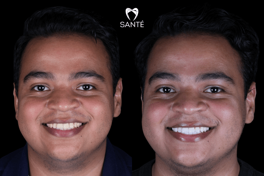 sensibilidade dentes clareamento