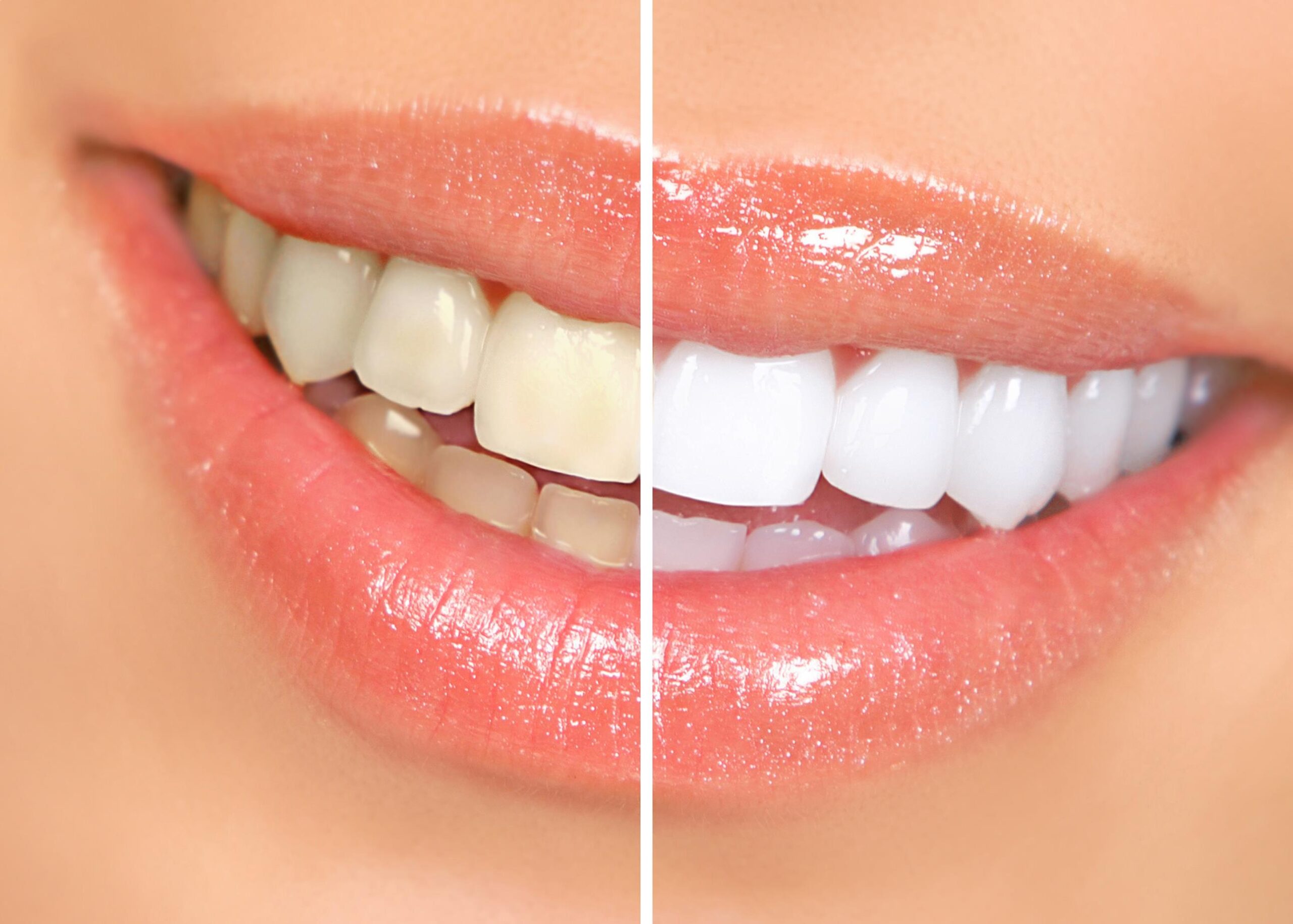 quanto tempo dura clareamento dental