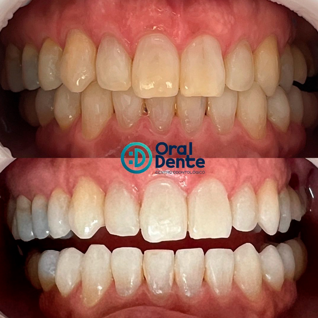 melhor clareamento dental